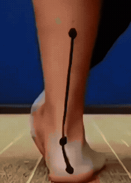 A real heel filmed from behind, with a bent line drawn over it